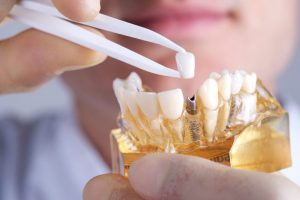 affordable dental implants in Ancaster