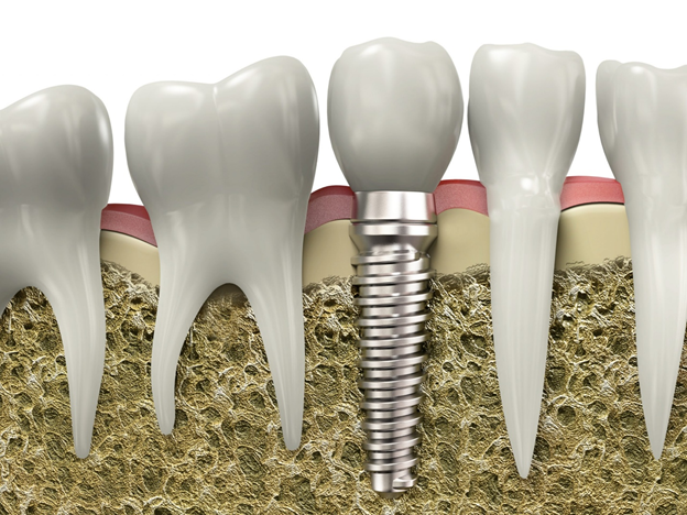 Installing Dental Implants for Smokers