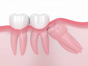 Important Considerations about Wisdom Tooth Extraction